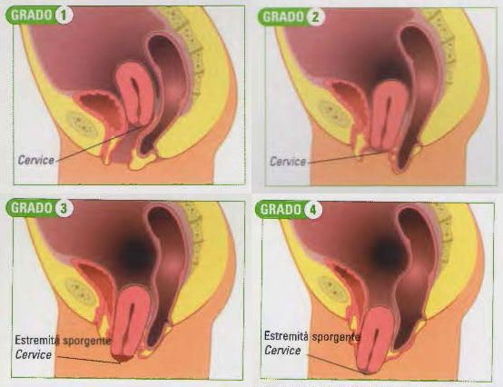 prolasso-utero
