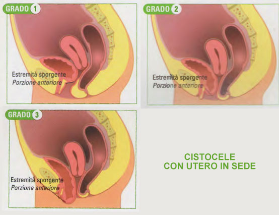 cistocele