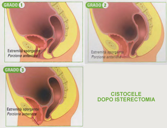 cistocele dopo isterec